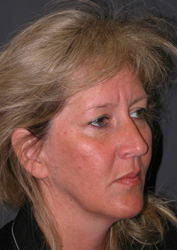 Mid Facelift - Patient 5 - Obl Right - Before